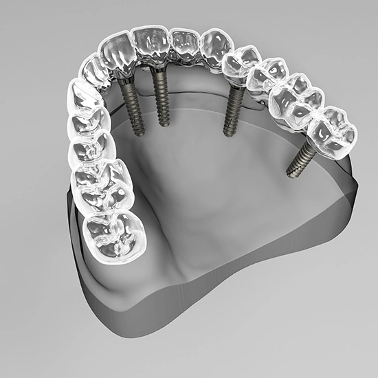 How Dental Implants Compare to Your Natural Teeth