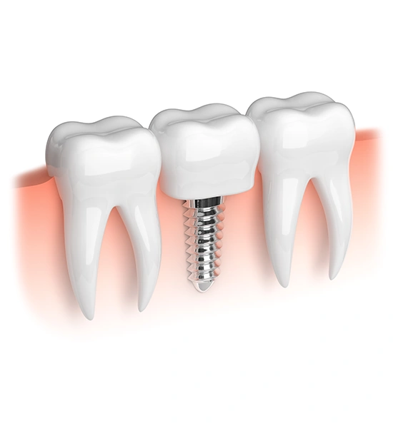 Single-Tooth Dental Implant Procedure