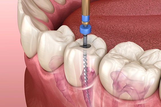 The Root Canal Procedure