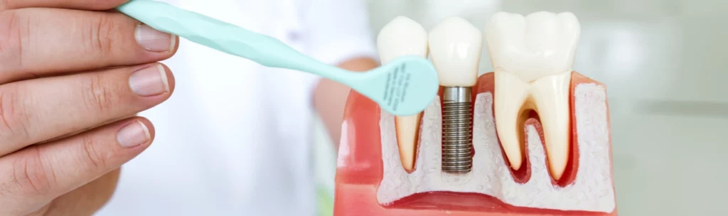 Can Dental Implants Cause Neurological Problems