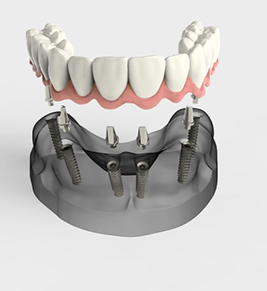 dental implants last