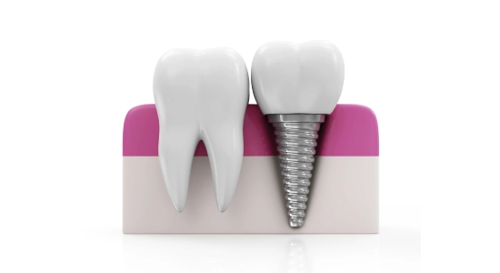 dental implant success rates