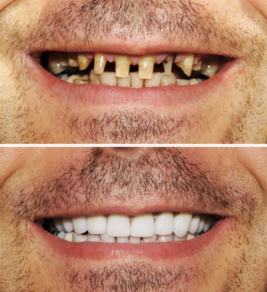 Before and after All-on-4 Dental Implants?