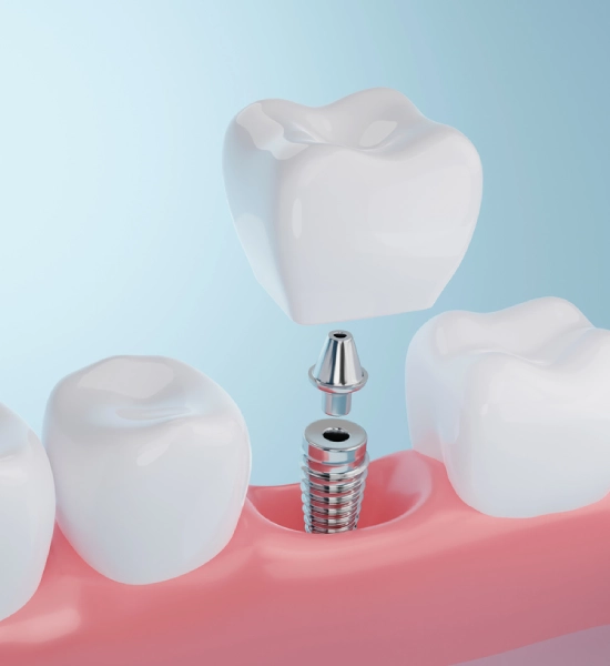 Can Your Body Reject a Dental Implant