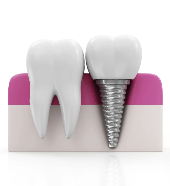 What is the Disadvantage of Implant Teeth