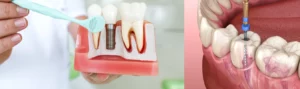 Is it better to have a root canal or dental implant